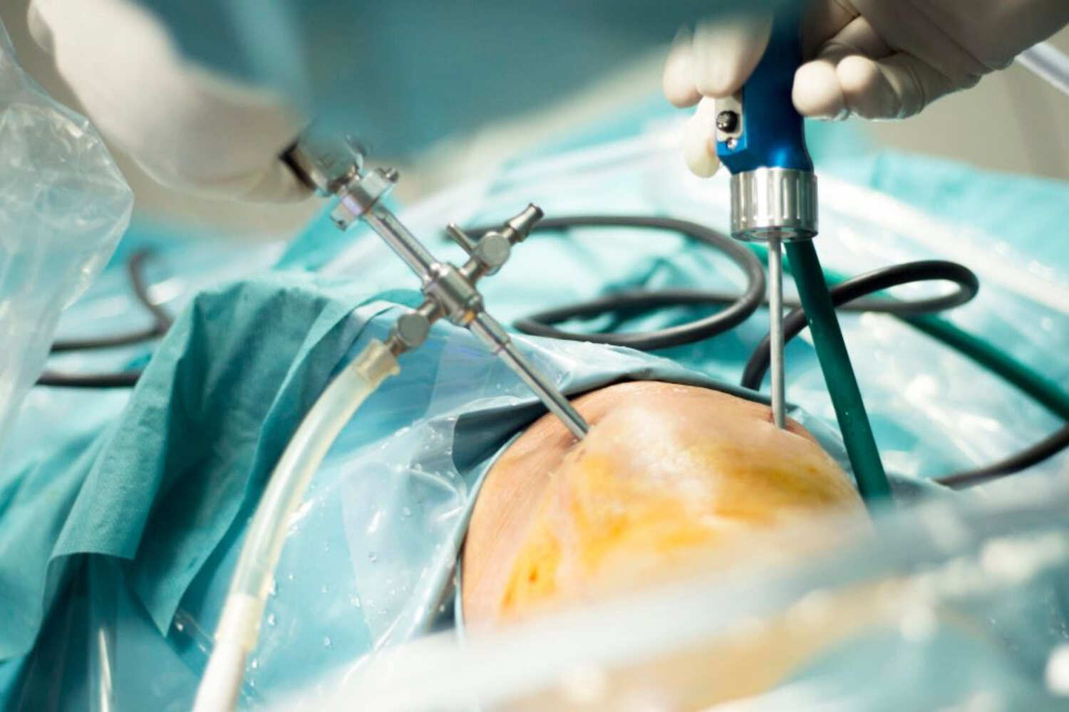 Artroscopia de Rodilla en Cuernavaca: Tratamiento Mínimamente Invasivo